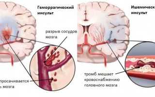 Как распознать и вылечить инсульт, перенесенный на ногах?