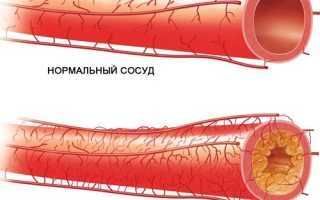 Лейкоареоз: что это, причины, признаки, лечение, формы, прогноз