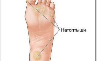 Натоптыши на пальцах ног: что это такое, и как от них избавиться?