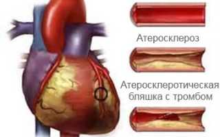 Нестабильная стенокардия — лечение и клинические рекомендации