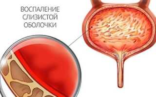 Может ли цистит спровоцировать задержку месячных и быть признаком беременности
