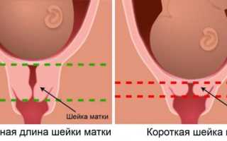 Короткая шейка матки при беременности: причины и лечение