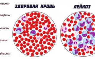 Показатели анализа крови при лейкозе у взрослых и детей