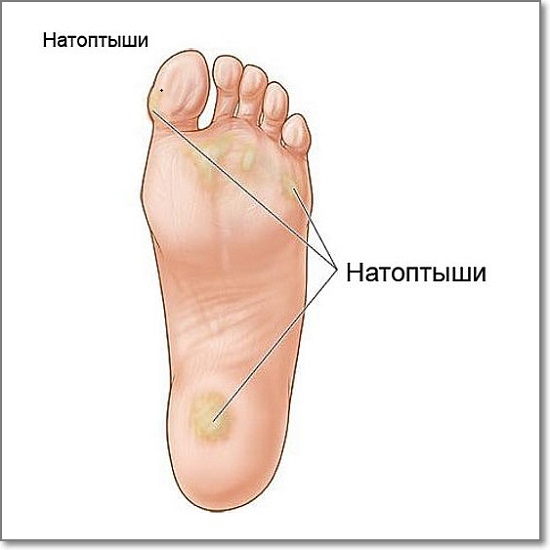 натоптыши на пальцах ног