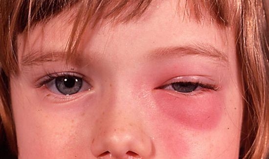 Симптомы гайморита