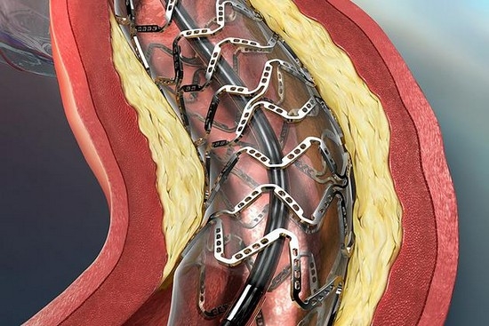 Что такое шунтирование сердца