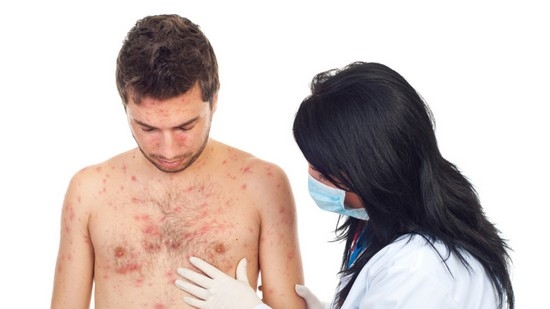 что такое опоясывающий лишай