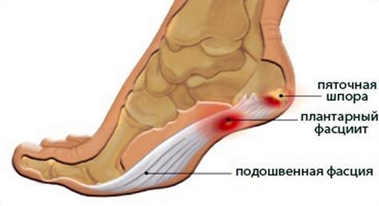 Лечение подошвенного фасциита в домашних условиях