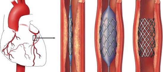 В чем суть шунтирования