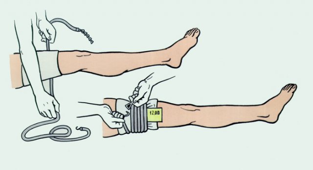 Кровоостанавливающая повязка