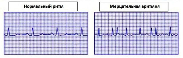 Ритм сердца